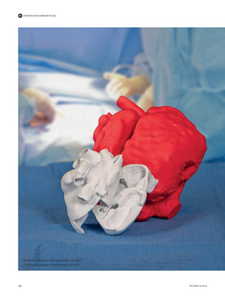 Titelbild des Artikels: ein 3D-Herzmodell mit Herzfehler.