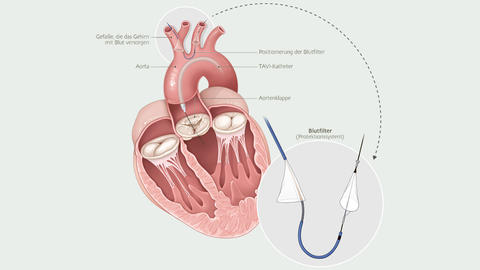 Darstellung eines TAAVI Schutzschirm 