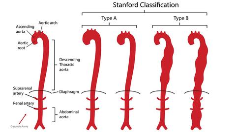 Die Aortendissektion: Klassifikation 