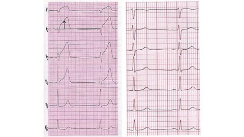 EKG bei Koronardissektion